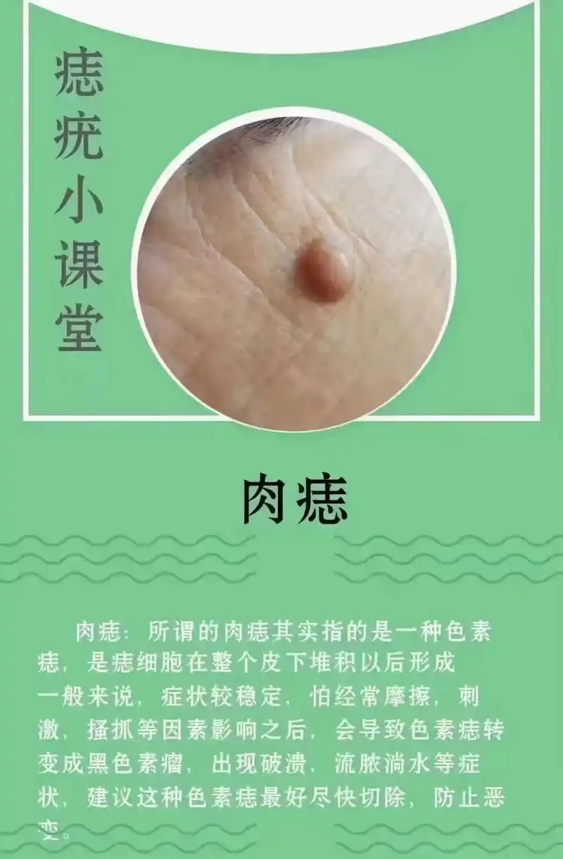 痣与疣,你认识多少个?#专业点痣 #美业手艺人  - 抖音