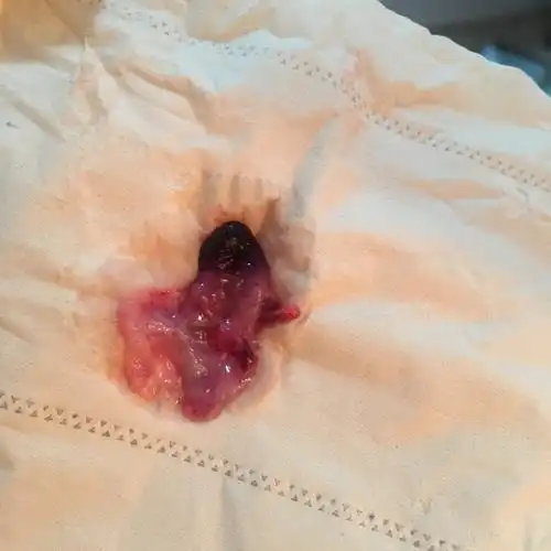 流血3天,排出像白带一样的东西,请问是先兆流产还是自然生化?