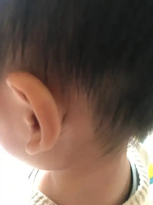 关于宝宝耳朵粘连的后续