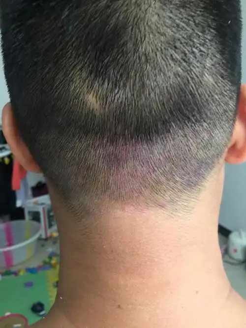 头皮上面红红的是什么?