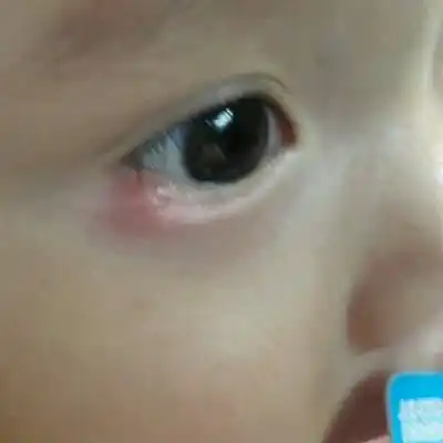 宝宝眼睛长了个小包,好几天了,怎麼办呀