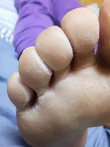 这脚每天出汗严重,还很臭,不痒.这怎么办?