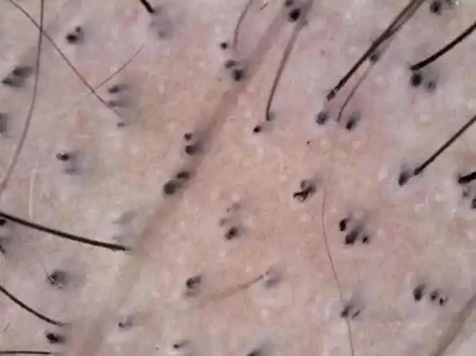 儿童脱发小心拔毛癖