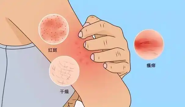 一到春季就皮肤瘙痒?多见是湿热,一个中成药,清热解毒 燥湿止痒