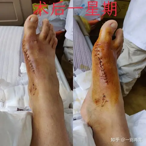 20年底拇外翻截骨矫形手术术后一个月