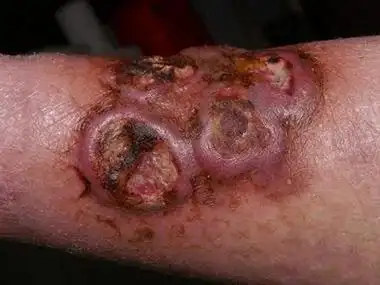 结节性脂膜炎的症状和图片 - 有来医生