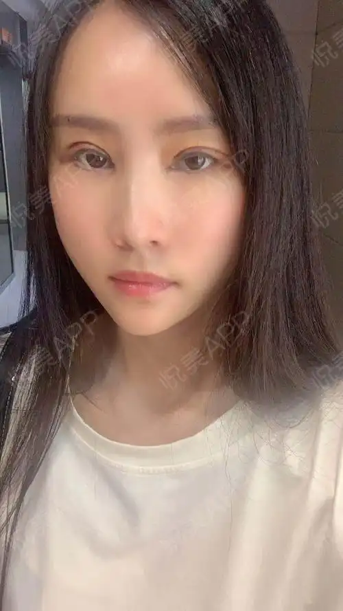 全切双眼皮术后3天_双眼皮术后3天_眼部整形术后3天_是你的清风吗分享