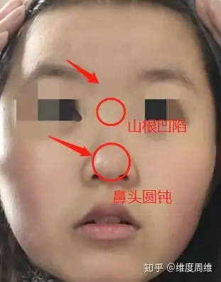 一点鼻梁都没有怎么办