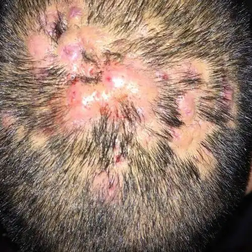 男童头皮毛囊炎康复图片_有来医生