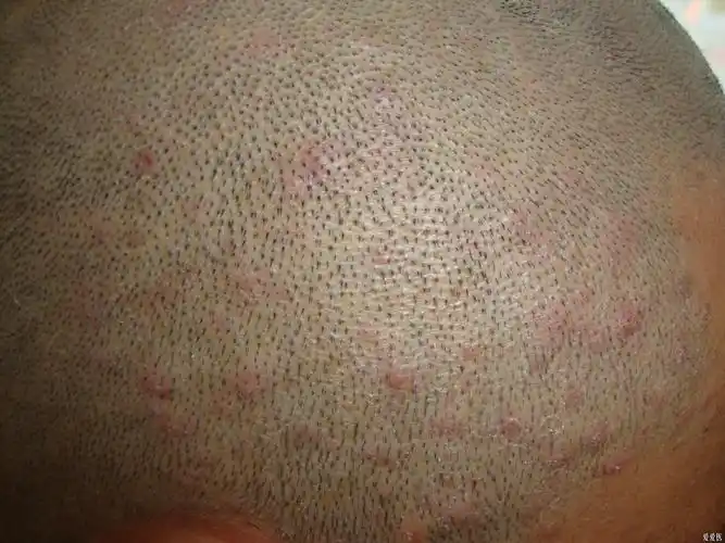 今天的病人头皮发痒20余天