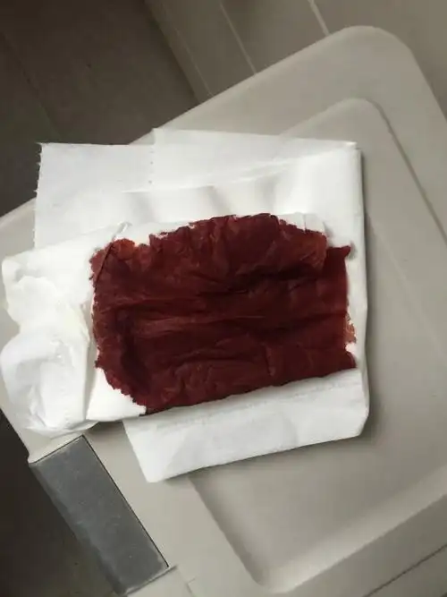 之前怀孕15周住院保胎治疗,胎盘低子宫积血,现怀孕16周又开始流褐色血