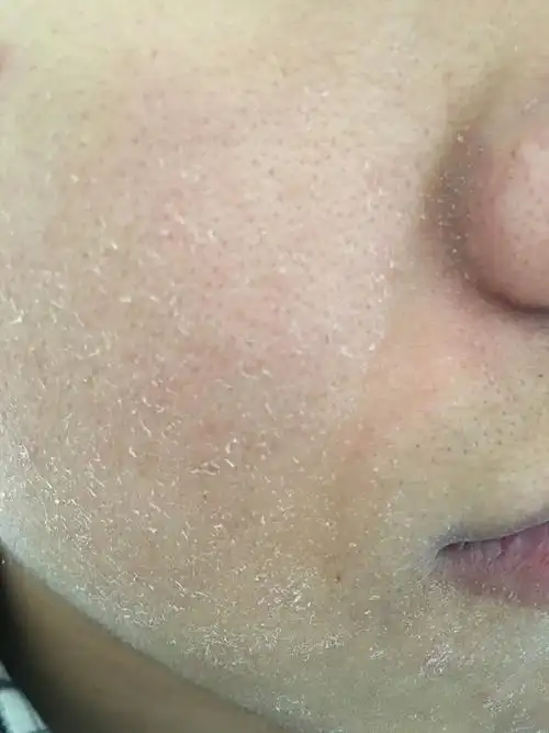 脸上长的是黑头吗脸部过干起皮怎么解决