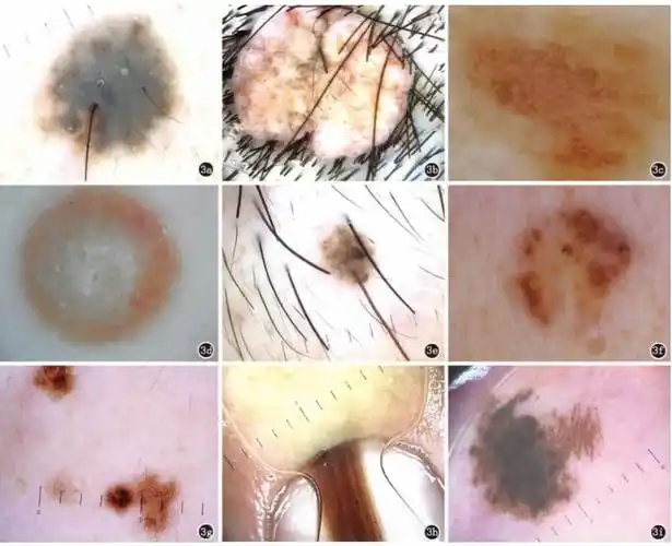 色痣皮肤镜诊断