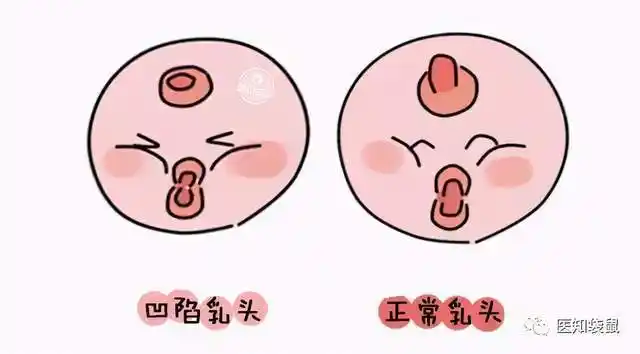 乳头|孕激素_网易订阅