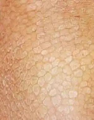 怎么防止鱼鳞病分散?