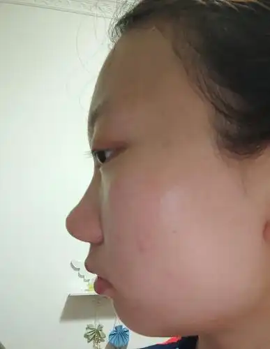塌鼻梁鼻翼很宽的典型代表 大家觉得我的鼻子需要动吗 上个对比图