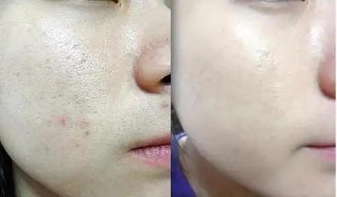 用完化妆水后,一般人会再搽些乳液面霜来滋润皮肤,但通常毛孔粗大的人