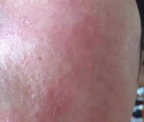 敏感皮肤的特征及保养