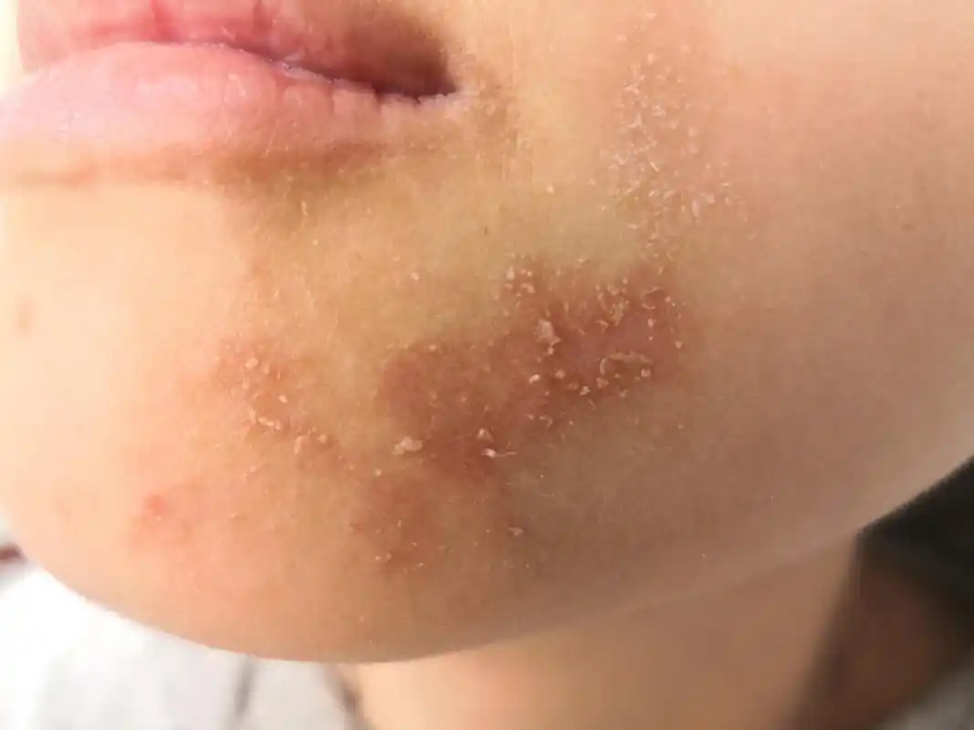 考虑接触性皮炎#解决皮肤问题专注皮肤美容##过敏#使用化妆品过敏的