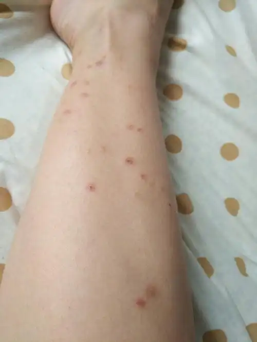 怀孕期间湿疹严重怎么办 妊娠痒疹和湿疹的区别图片