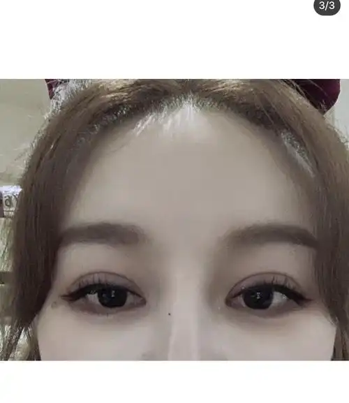 双眼皮割的太宽图片