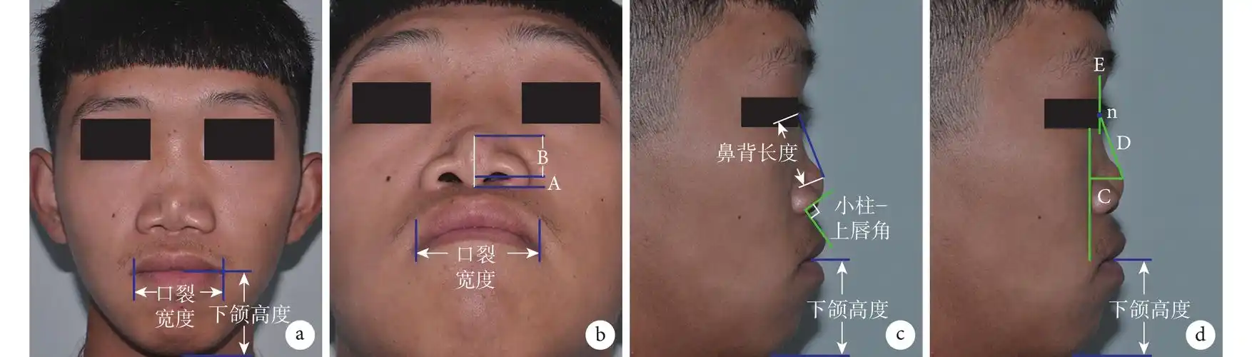 自体肋软骨移植技术修复binder综合征的疗效评价