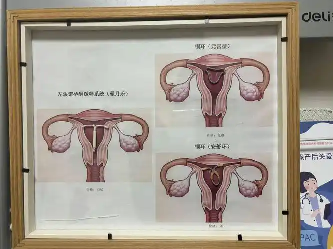节育器在体内的演示图不同代的中国女性和避孕在何晓英的观察中,不同