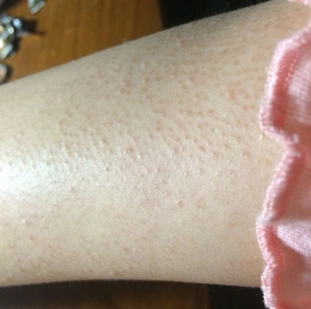 而皮肤是相当常见的皮肤问题,它是一种角质化代谢异常的体显性遗传,有