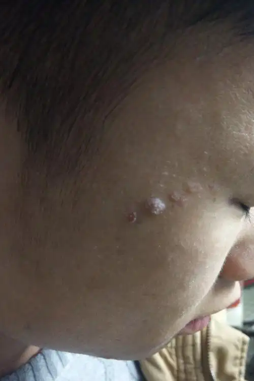 我的脸上的疣一样的东西!