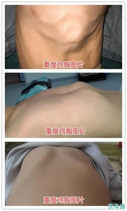 2,宝宝鸡胸图片和正常图片