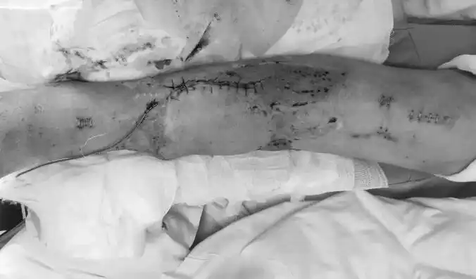 车祸多处骨折 必须截肢?沈积专家保住了他的腿