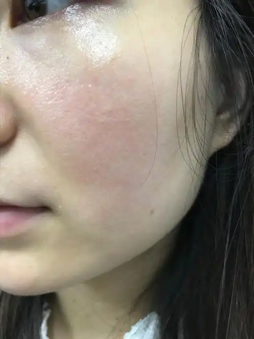 确诊脂溢性皮炎几年了,一直反反复复,泛红,长点点,红色丘疹