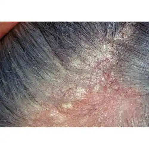 p>当男孩出现头皮屑问题时,选择合适的洗发水至关重要.