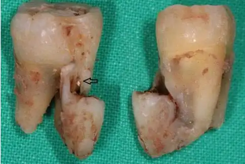 罕见双生牙难分舍
