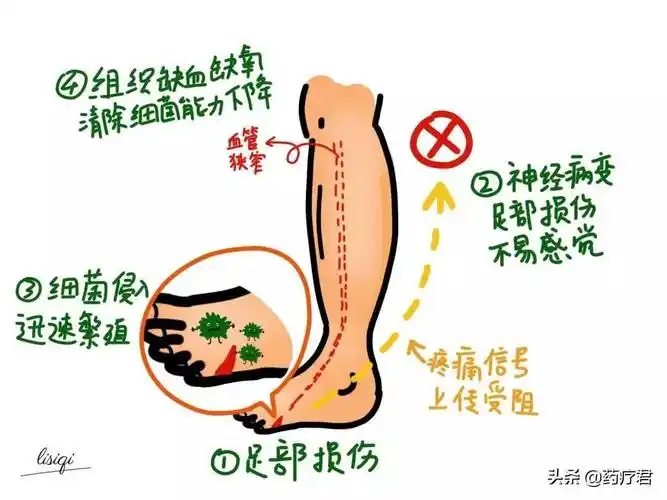 糖友注意出现脚麻脚疼别不当回事或是神经病变的信号