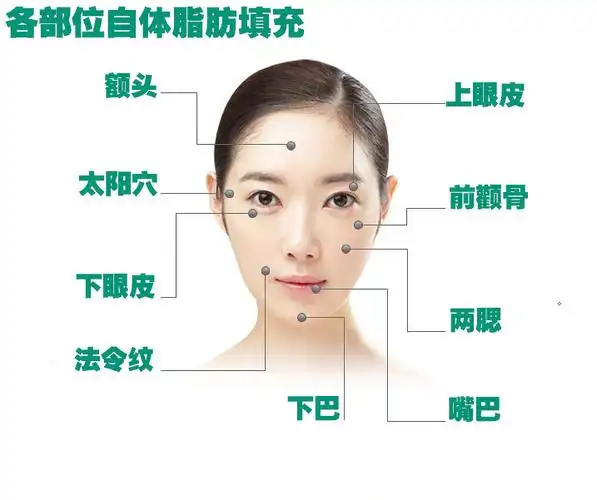 面部脂肪填充可以填充哪些部位?