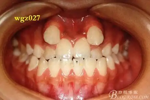 上颌尖牙越位患者的x线摄片原创