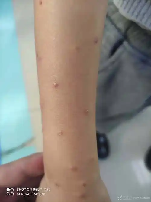 医生但是经常有儿童皮肤病来看最近看了好几例相同的皮疹查阅皮肤病图