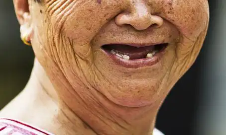 牙齿缺失后应该怎么办?