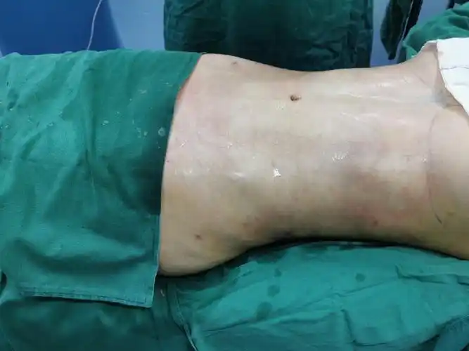 360度环形吸脂,吸脂仪器有哪几种 - 寻找优惠券 - 九块九手游导航