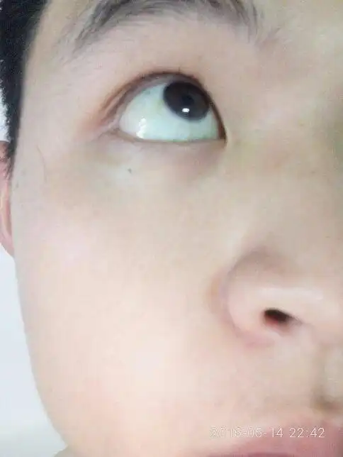 眼睛里有斑块,眼白发蓝,小时候得过溶血性贫血,吃蚕豆引起的,请问眼白