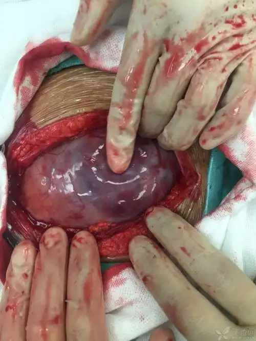 中央型前置胎盘伴植入 孕35周 胎死宫内 [病例帖]