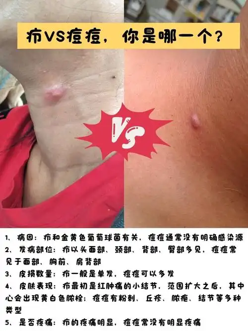 脖子上长了一个硬硬的包?可能是疖找上门啦!