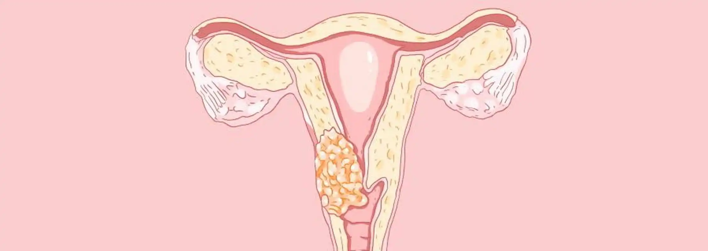 抽烟,据研究显示,每天在二手烟环境中生活的女性,会增加22%的患宫颈癌