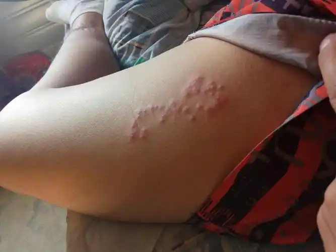 腿上起了一圈像8字的疙瘩,越挠越痒.请问这是虫子咬的还是皮肤病.