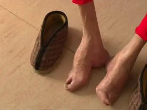 龙海104岁裹足老人享晚年 "三寸金莲"述沧桑岁月