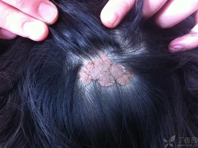 6岁儿童头皮异物,2*3cm,出生时就有,每年扩大,求教,这是什么?