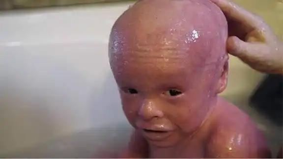 鱼鳞病儿童皮肤以10倍的速度生长