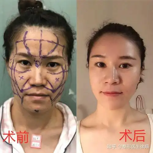 自体脂肪全脸填充案例