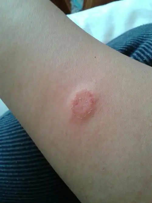 大约3,4号的一天觉得胳膊痒痒的就给胳膊挠破了一点,8号打的乙肝疫苗